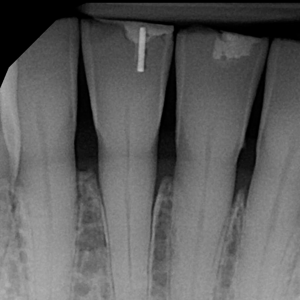 patient x-ray after procedure in tighter frame