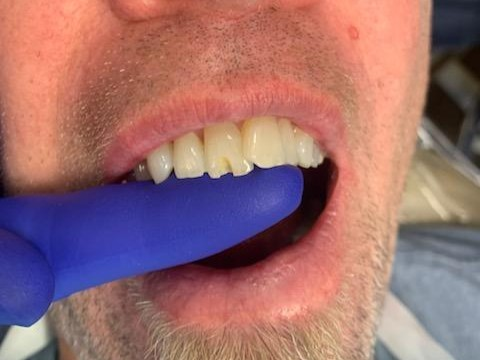 Patient 13 chipped tooth prior to DentXpin fiber optic post repair.