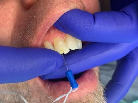 Patient 13 tooth with initial DentXpin fiber optic post insertion.