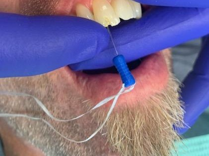 Patient 13 tooth with initial DentXpin fiber optic post insertion showing floss attached to pin.