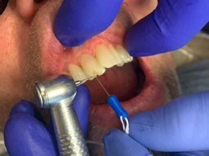 Patient 13 breaking DentXpin to correct length for reconstructing.
