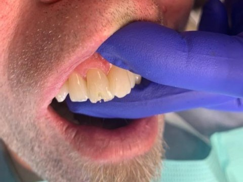 Patient 13 fiber optic DentXpin post positioned inside tooth.