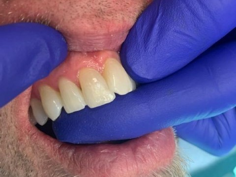 Patient 13 final restoration after DentXpin fiber optic reinforcement.