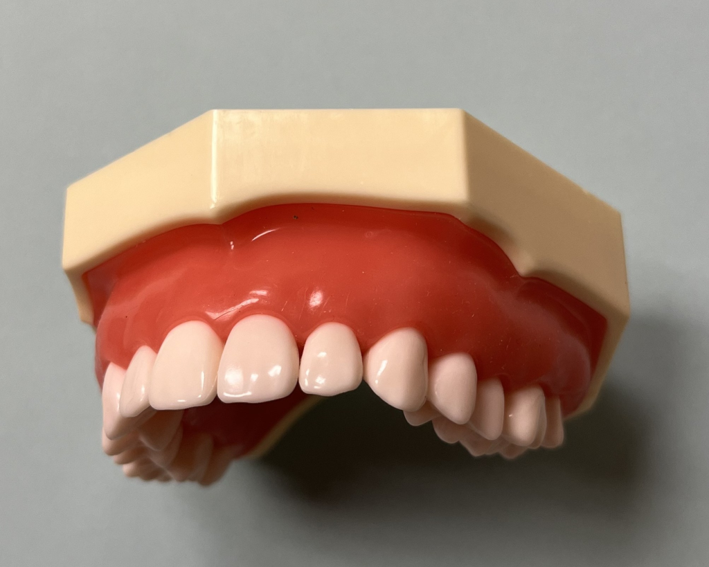 Post DentXpin tooth repair showing aesthetic reconstruction.