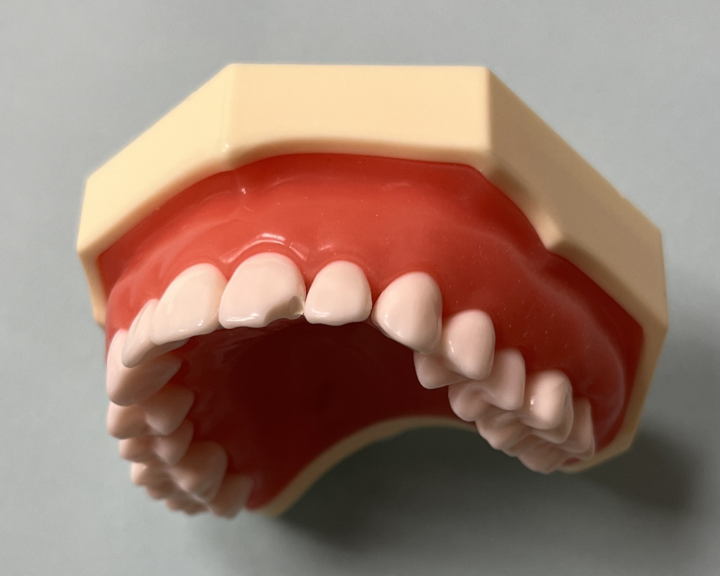 Model of upper jaw with chipped front tooth.