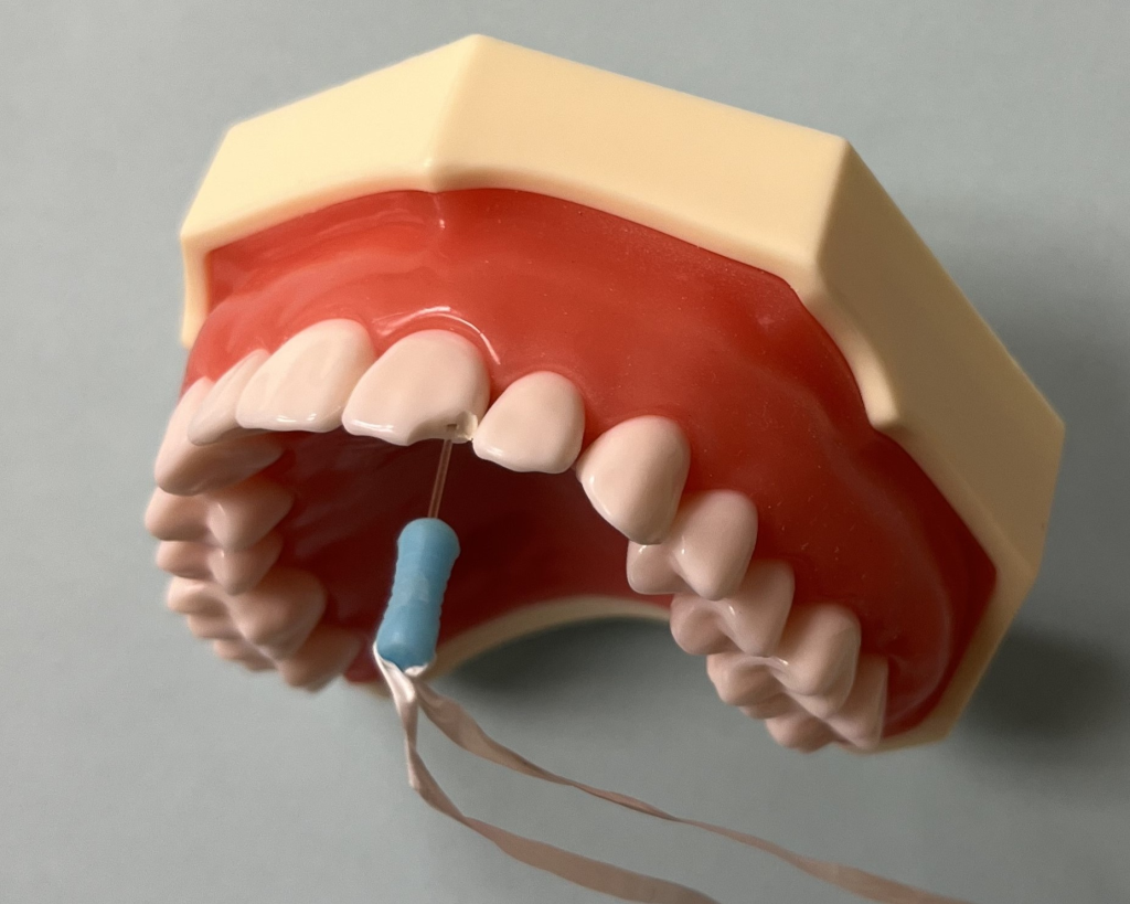 DentXpin inserted into the tooth.