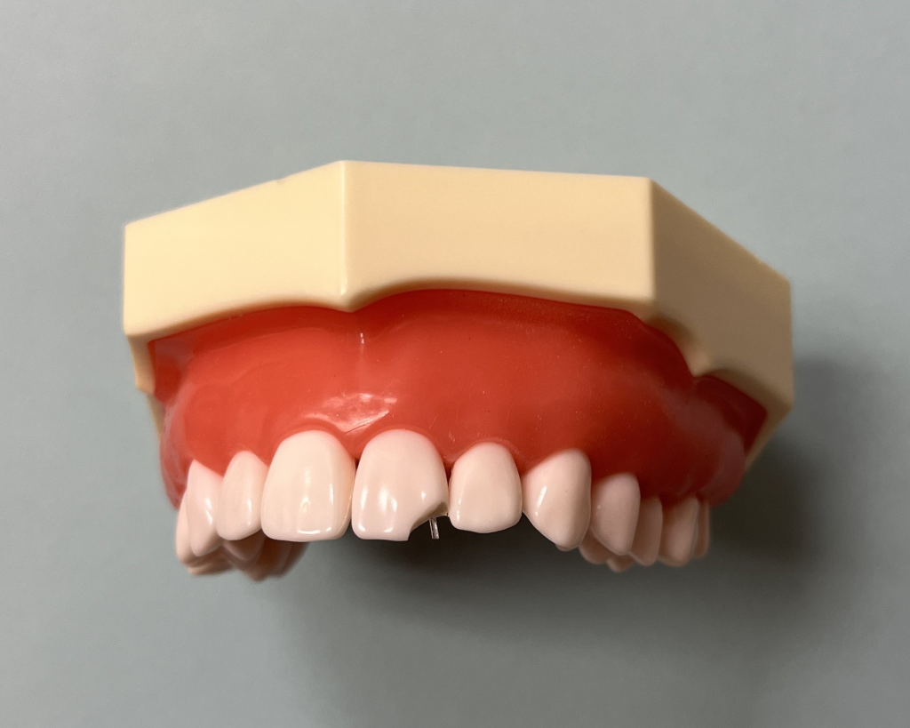 DentXpin cut to proper length for the tooth.