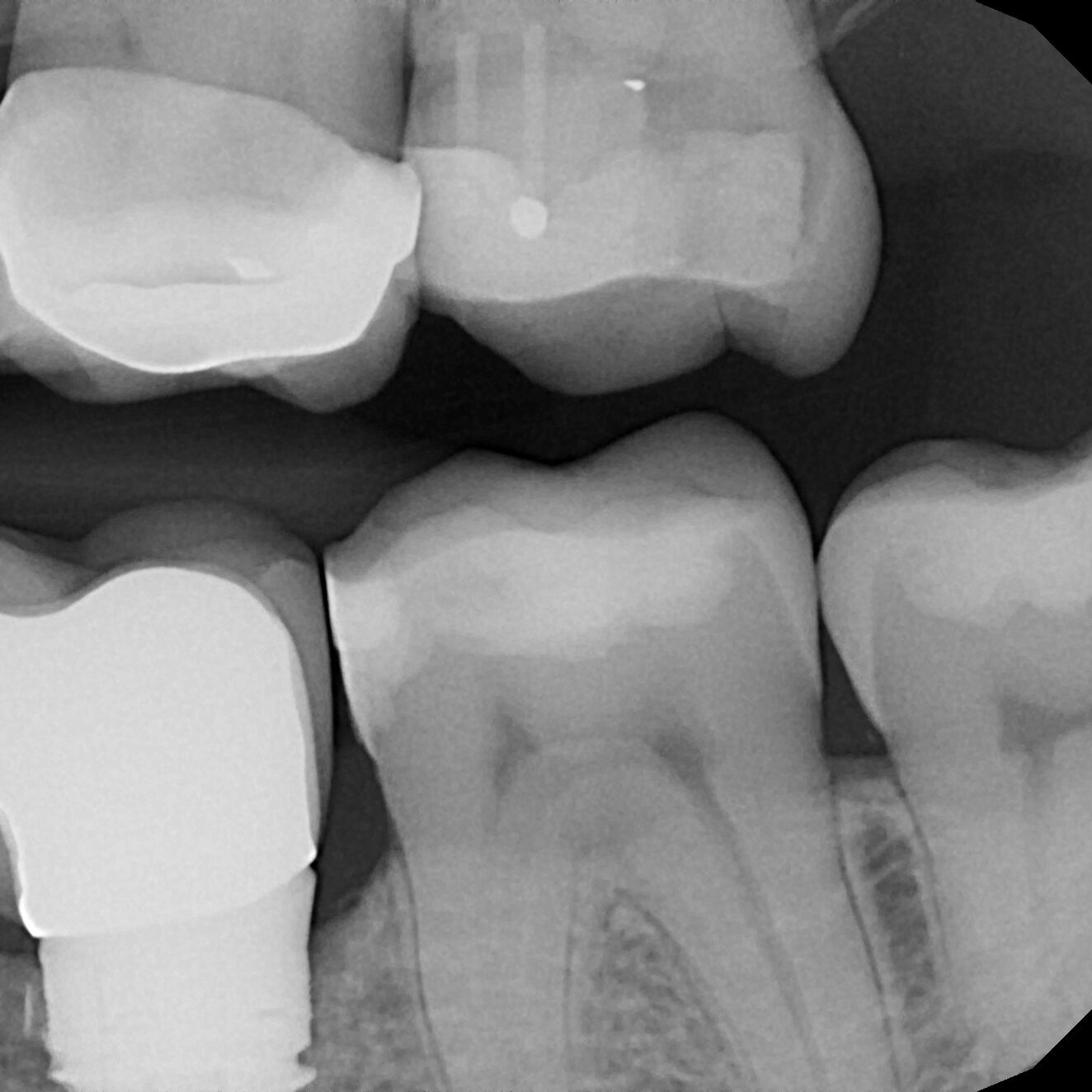 X-ray of double DentXpin used in tooth reconstruction