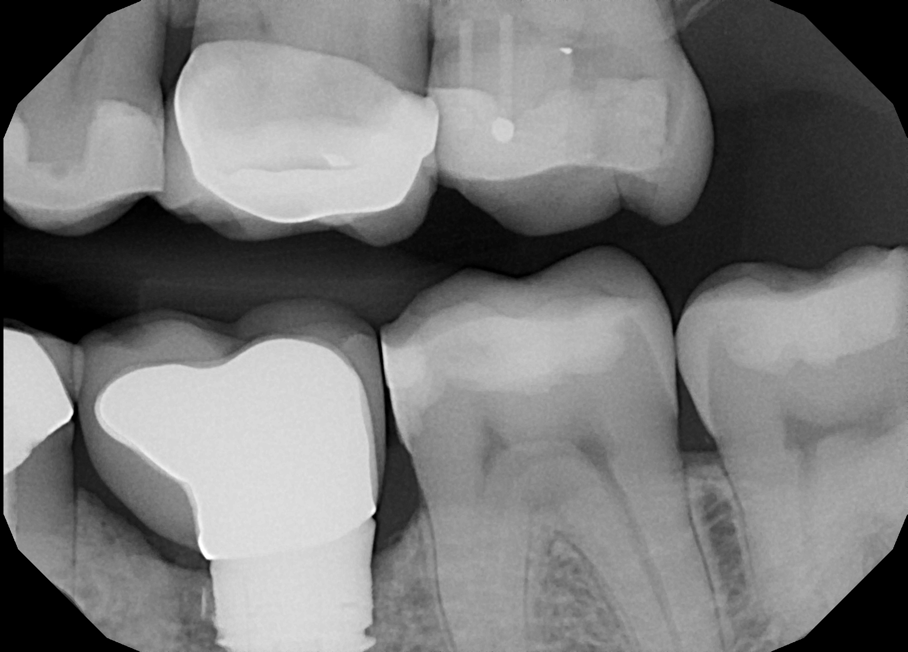 X-ray of double DentXpin in tooth reconstruction.