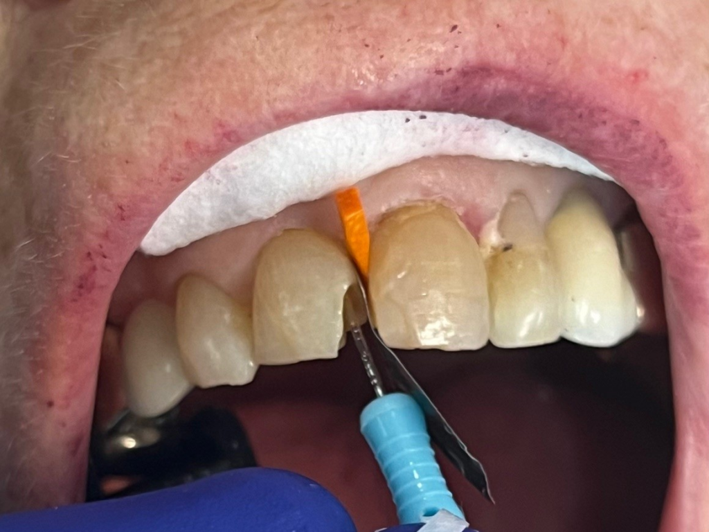 Patient 1 tooth prepared for restoration before DentXpin placement.