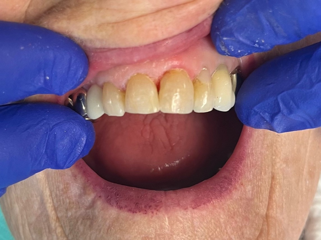 Patient 1 completed tooth repair after DentXpin restoration with natural aesthetic result.