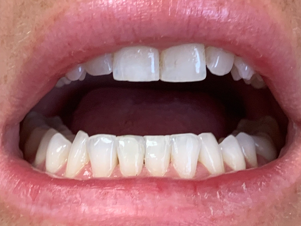 Patient 10 restored tooth close up after fiber optic DentXpin reinforcement.