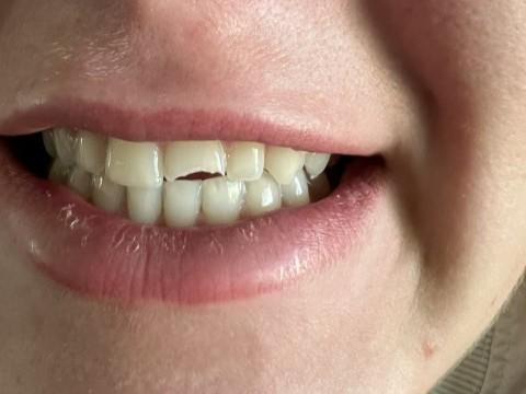 Patient 11 damaged tooth before DentXpin fiber optic procedure.
