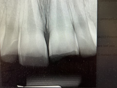 Patient 11 x-ray showing damaged tooth before DentXpin procedure.