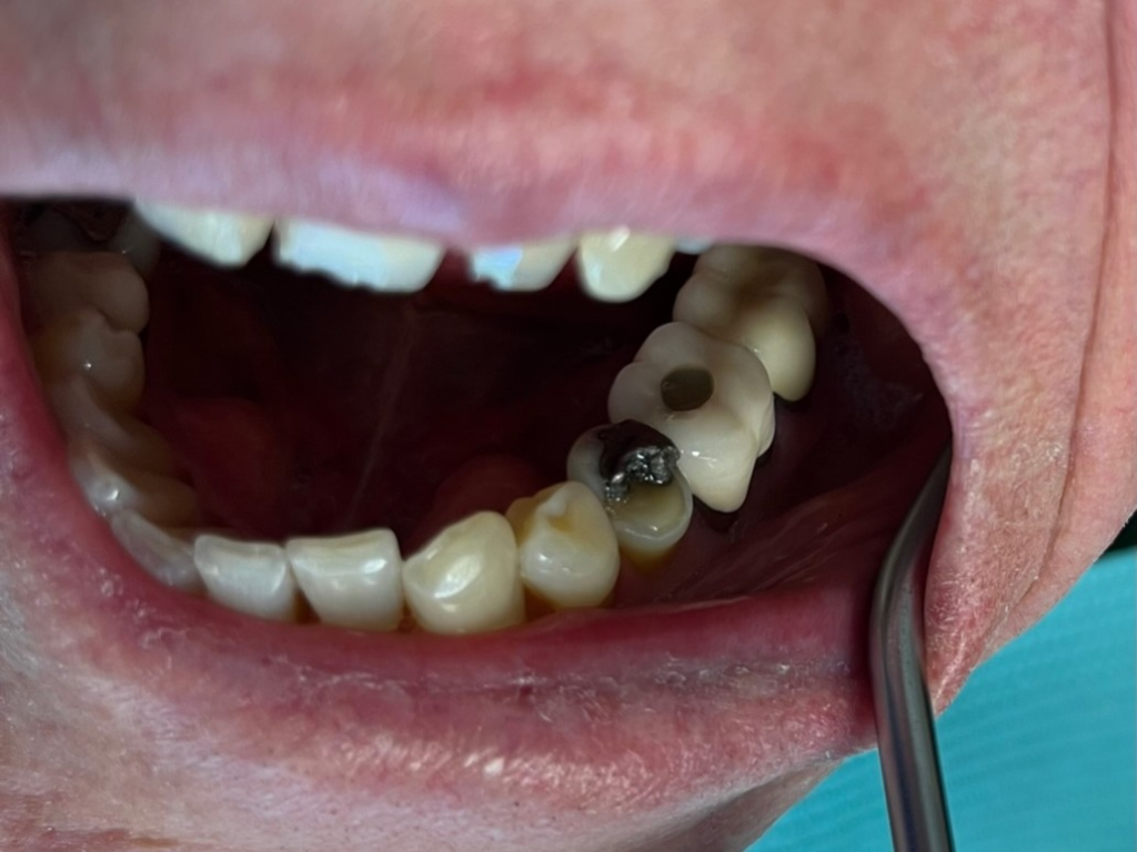Patient 12 pre-treatment image showing broken tooth structure before DentXpin procedure.