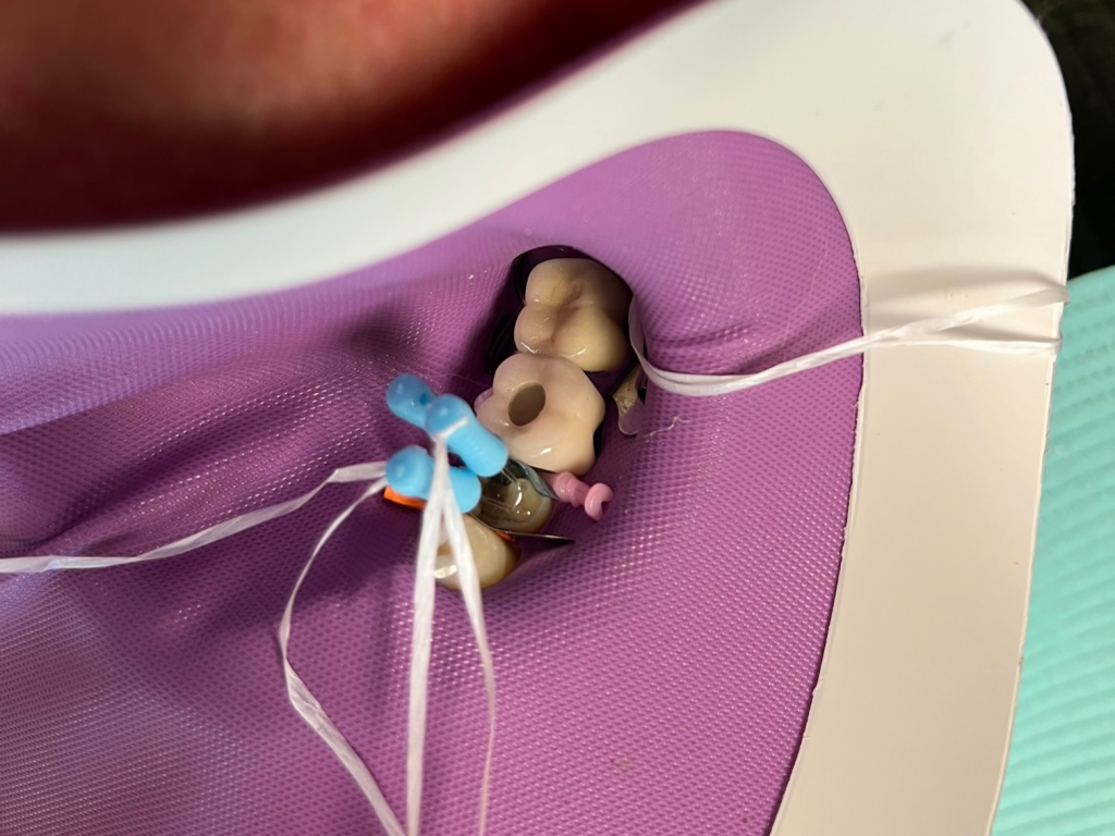 Patient 12 fiber optic post bonded during DentXpin restoration process.