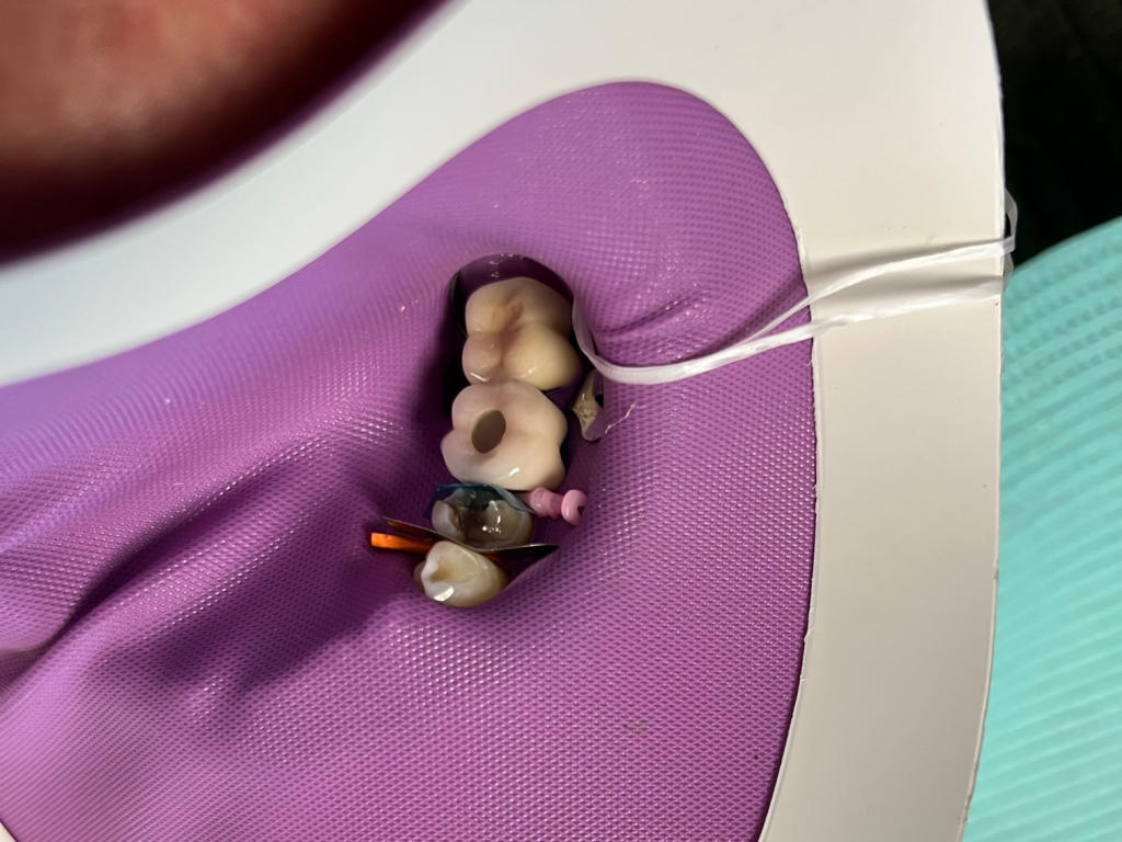 Patient 12 core buildup completed over DentXpin for structural reinforcement - angle 2.