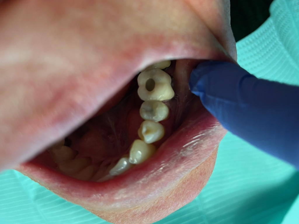 Patient 12 completed aesthetic tooth repair following DentXpin procedure.