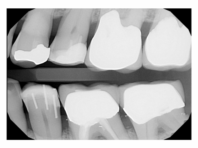 Patient 12 dental X-ray showing DentXpin fiber optic post positioned within tooth.