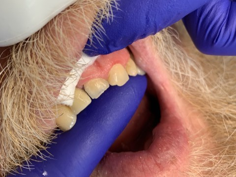 Patient 2 before repair showing fractured tooth prior to DentXpin fiber optic post restoration.
