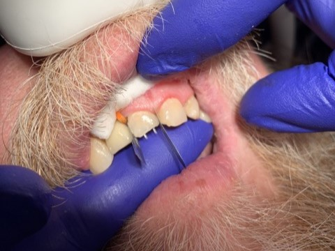 Patient 2 Dual DentXpin fiber optic posts positioned.