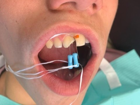 Patient 3 DentXpin fiber optic post insertion process to stabilize damaged tooth structure.