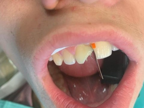 Patient 3 DentXpin fiber optic post inserted to stabilize damaged tooth structure.
