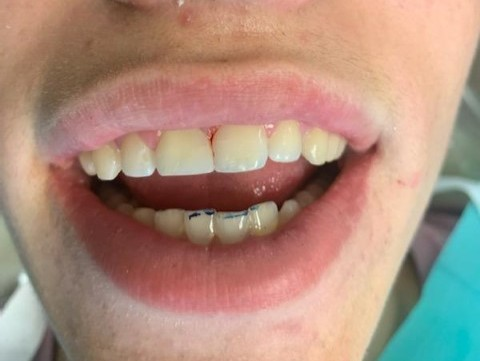 Patient 3 completed aesthetic restoration following DentXpin fiber optic procedure.