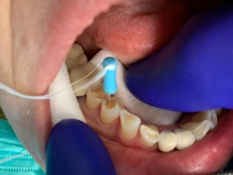 Patient 5 DentXpin fiber optic post bonding.