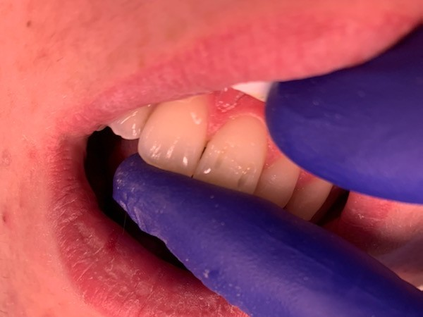 Patient 6 DentXpin fiber optic post positioned to reinforce tooth structure.