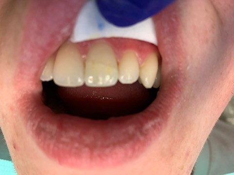 Patient 6 angle 1 final restoration completed after fiber optic DentXpin procedure.