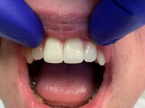 Patient 6 angle 2 final restoration completed after fiber optic DentXpin procedure.