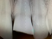 Patient 6 x-ray showing broken tooth prior to repair.