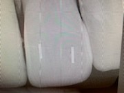 Patient 6 x-ray showing broken tooth after repair with DentXpins.