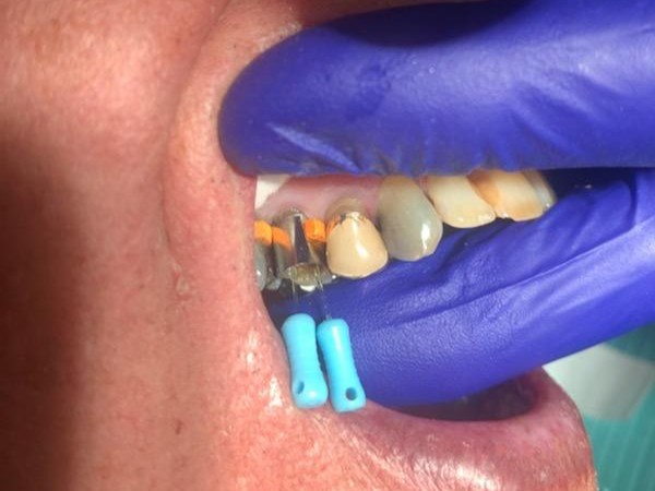 Patient 8 DentXpin fiber optic post positioned during restorative procedure.