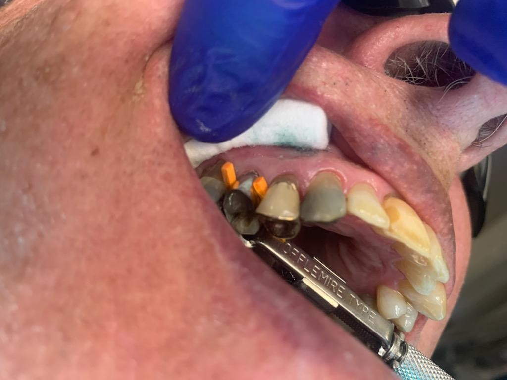 Patient 8 tooth prepared for DentXpin fiber optic post placement.