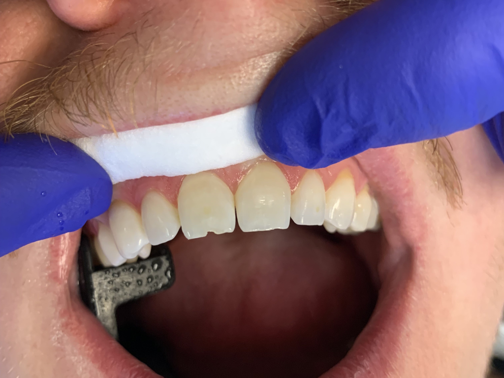 Patient 9 small chipped front tooth before treatment.