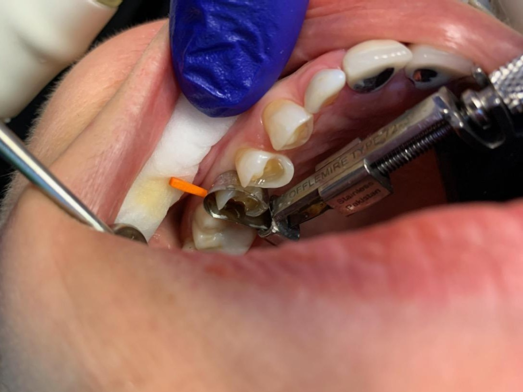 Patient 7 before treatment showing fractured tooth requiring structural reinforcement.