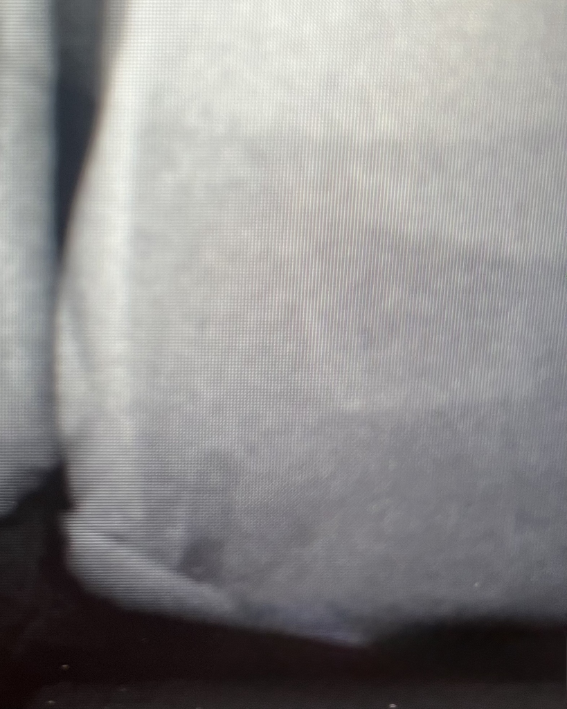 X-ray of single DentXpin used in tooth reconstruction